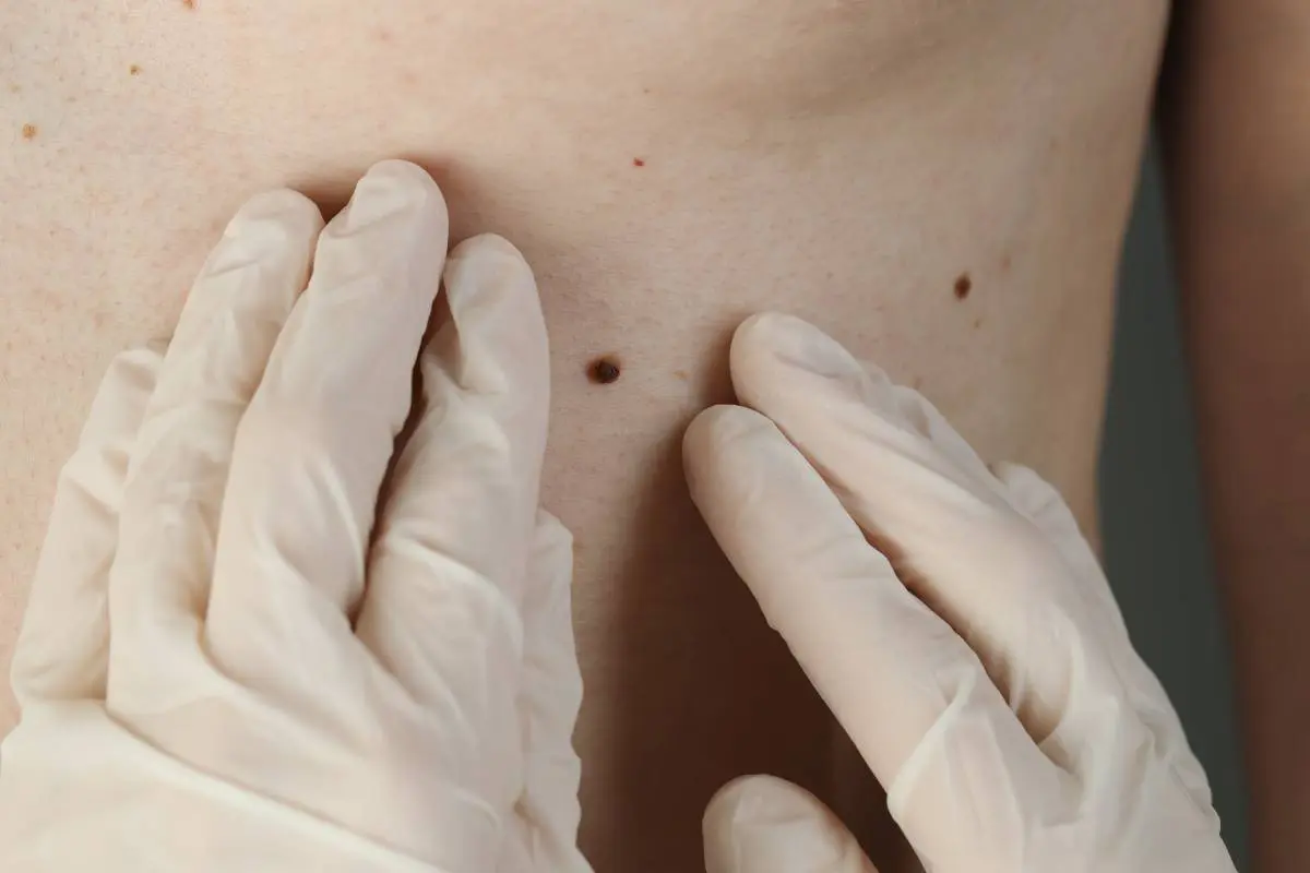 gloved hands of a dermatologist examining a mole on a patient's back during an exam