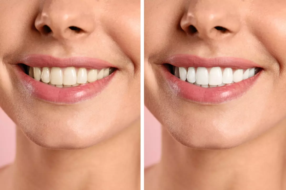 Before and after photos of teeth whitening procedure